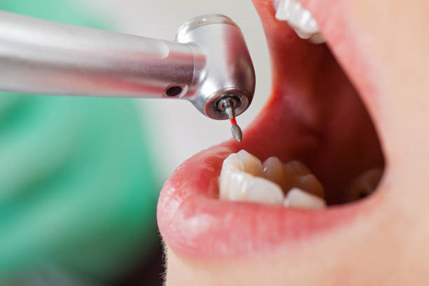 Best Emergency Wisdom Teeth Removal in Snyder, OK